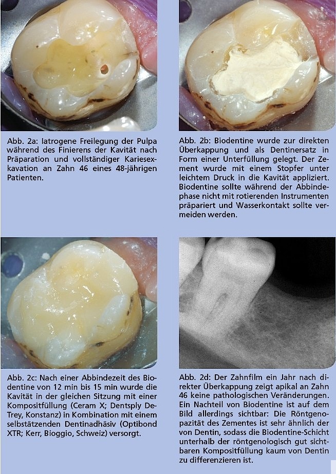 Was ist ein Dentinadhäsiv?