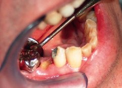 Eine Alveolitis sicca kann etwa 2 bis 4 Tage nach einer Zahnextraktion auft...